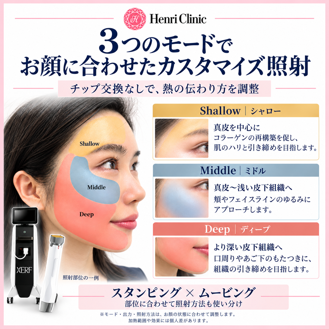 3つの深さと2つの照射方法で、お顔に合わせた引き締めを
