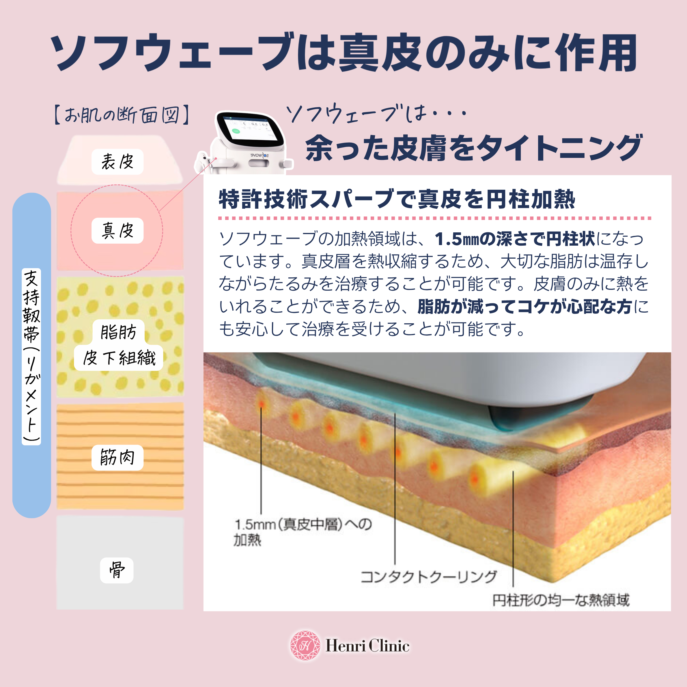 SUPERB™による真皮リモデリング