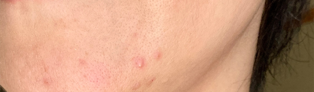 くり返す大人ニキビと、そのあとに残る赤み