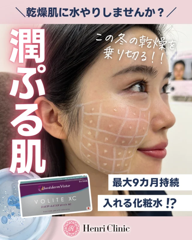 \乾燥肌に“入れる化粧水”💧/
肌の上から塗るだけ!?
ヒアルロン酸で潤いを“肌の中にストック”する時代!?💉
💠 ジュビダームボライトXC
ボライトは1回の注入で、最大9カ月うるおい持続する肌育ヒアルロン酸注射です✨
乾燥・くすみ・小じわ・ハリ不足にアプローチして“内側から水分を抱える肌”へ❤️
💧表面に塗るスキンケアでは届かない真皮層に、じっくりと潤いをチャージします😊
「最近ファンデのノリが悪い…」「保湿しても乾く…」
そんな方におすすめです✨
この冬は、“潤ぷる肌”で乾燥知らず❄⛄
肌の未来のために、この秋ボライトチャージしてみませんか?
📍アンリクリニック名古屋院
#ボライト #ヒアルロン酸#入れる化粧水 #肌育#乾燥肌ケア#名古屋美容 #アンリクリニック名古屋院