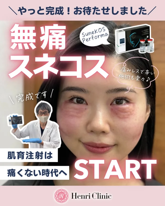 📢 ついに完成しました!無痛スネコス💉
「痛みに耐える肌育」はもう終わり😤
HenriClini名古屋院では、極細針だけではなく特殊ブレンドで配合した麻酔で“痛みレス”で肌育を叶えるスネコスがスタートしました✨💖
先にスタートした無痛プルリアルは大好評で、1回するともう普通の肌育には戻れないという方が続出🔥🫣🥹
🌿スネコスパフォルマとはお肌のコラーゲン・エラスチンを再構築し、小じわやハリ・弾力・透明感を底上げ💎
痛くないからこそ、継続できる肌育時代へ突入🍀
※痛みの感じ方には個人差がございます
※針のお痛みは多少ございます
#スネコス #無痛 #肌育 #アンリクリニック名古屋院 #無痛スネコス