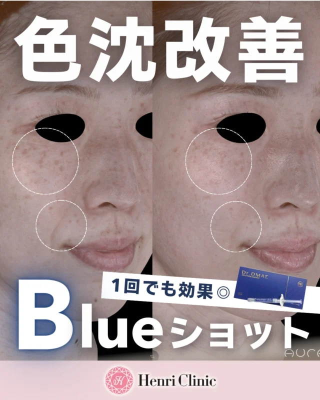 ＼ 色沈・くすみ改善に ／
Blueショット💙

1回でもトーンUP&色素沈着の改善効果😮👏
色ムラ、くすみが気になる方に◎

ハリが引き出されたことにより法令線まで薄く変化しています✨

透明感チャージはBlueショットにお任せください💙✨

※効果には個人差がございます
施術メニュー：Blueショット1回
⁠施術間隔：3回1クール持続半年程度
リスク・副作用：内出血・針跡・赤み・施術中の痛み・アレルギー反応など
ダウンタイム：腫れ・むくみ・内出血・針跡など
治療価格：1回定価44,000円

#肌育#アンリクリニック名古屋院