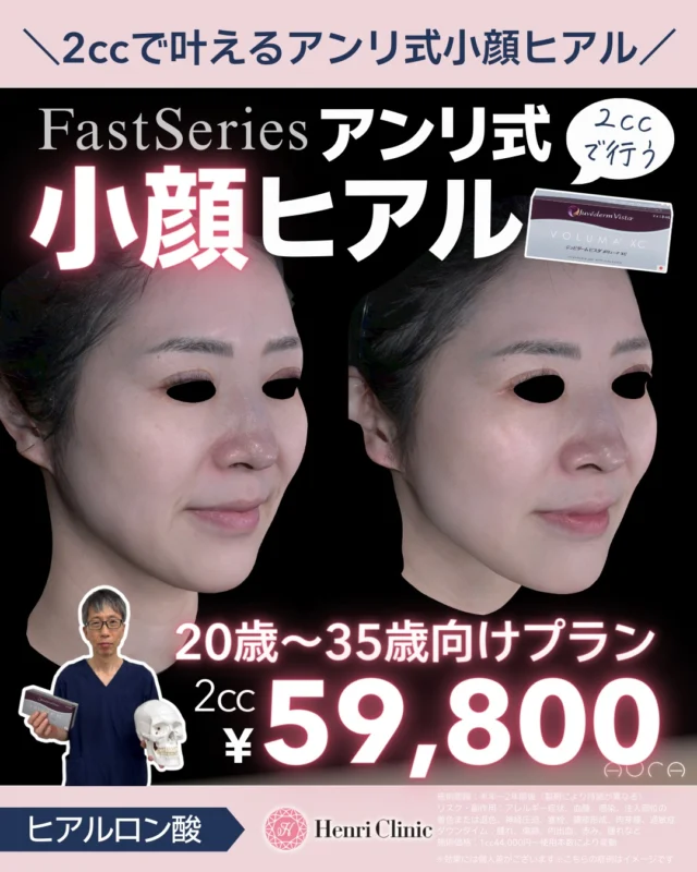 ファーストシリーズ「アンリ式小顔ヒアル」誕生💉

「ヒアル＝顔が大きくなる」🥺
そんなイメージ、ありませんか？

アンリ式小顔ヒアルは入れすぎない・盛りすぎないを大切にした「20〜35歳のためのファーストヒアル。」🎉

使うのはたった2cc😮
必要なところに、必要な量だけを分散注入しフェイスラインの重心を整えながら自然に“キュッと小顔”な印象へ導きます👏😮

✔ フェイスラインのもたつきが気になる
✔ 小顔になりたいけど不自然は避けたい
✔ ヒアルが初めてで不安
✔ 今の顔立ちを活かしたまま整えたい

そんな方におすすめです😊

「バレずに変わる」それがアンリ式小顔ヒアル💉

まずはお気軽にご相談ください🩺✨

＼ファーストシリーズ第一弾／
アンリ式小顔ヒアル誕生を記念して、キャンペーンを期間限定で実施✨

💉アンリ式小顔ヒアル（FastSeries）
20歳〜35歳向けプラン🌸
🔹 ヒアルロン酸 2cc
💰 ¥66,000（税込）
🔹 症例モニター価格
💰 ¥59,800（税込）

※使用製剤：ジュビダームシリーズ
※別途カニューレ代 ¥3,300
※モニター様の場合は症例写真のご協力をお願いしています

#ヒアルロン酸注入