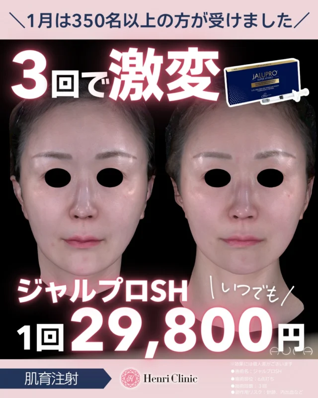 ＼ジャルプロと言えばアンリです／
3回で“激変”を実感する肌育注射✨

ジャルプロは、ただの肌育注射ではなくリガメント（支持靭帯）にアプローチし、真皮の線維芽細胞を刺激することでコラーゲン・エラスチンの再構築を促します✨

✔ フェイスラインのゆるみ
✔ 中顔面の間延び
✔ 法令線
✔ ハリ・ツヤの低下

「自然に引き締めたい」「やりすぎたくない」😢
そんな方に選ばれている治療です💉

📊実績
2026年1月だけで、350名以上の方がアンリ名古屋でジャルプロを受けられました🎉😮
私たちもビックリです（笑）

リピーター・ご紹介が多いのも、ジャルプロがいい製剤で結果を出してくれるから👏

💎モニター様施術内容
・ジャルプロSH
・基本の6点打ち
・回数：3回
※効果には個人差があります

🌸キャンペーン情報
ジャルプロSH 1回 ¥29,800
※🔰初診様・再診の患者様関係なくこちらの価格です✨

📍ご予約は【WEB】から受付中
SNSフォローも嬉しいです♪

#ジャルプロ