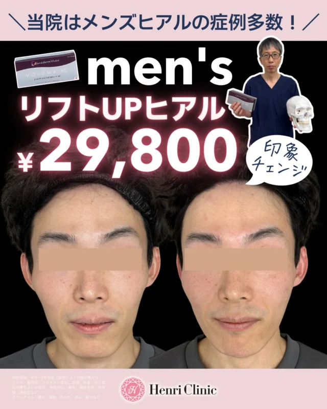 ＼ men’sヒアルはアンリへ ／
アンリでメンズヒアルの人気が急上昇中😮🔥

実は今。。。
✔ フェイスラインのもたつき
✔ ほうれい線
✔ 頬のコケ感
✔ 年齢による疲れ顔
に悩む男性が増えています🫣

アンリでは骨格を活かしたデザインで
“バレずに若返る”メンズヒアルをご提案します✨

男性だからこその注入法がございます💉

若々しく、そしてカッコよく、バレずに印象を変えたい方にはアンリのリフトアップヒアルにぜひお任せ下さいませ👔

🩺 担当：徐医師
診察から施術まで一貫対応します

――――――――――

🎉 men’s限定キャンペーン 🎉

通常 1cc ¥44,000
▶ 特別価格 1cc ¥29,800

※2cc以上より適応
対象期間：2/19〜2/28

――――――――――

✔ 自然にフェイスラインをシャープに
✔ 横顔を整えて洗練された印象へ
✔ 若々しく、清潔感アップ

「やりすぎない」
それが大人のメンズ美容はアンリ名古屋にお任せ下さい👏

無料カウンセリング受付中📩
ご予約はLINE・DM・HPから📱

#メンズ美容 #メンズヒアル #ヒアルロン酸注入