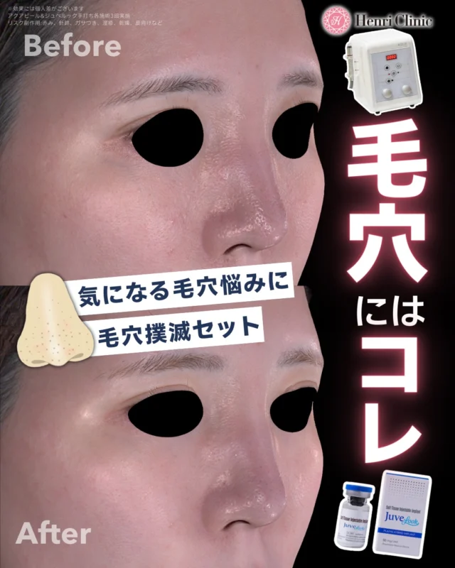 毛穴・ニキビ跡 本気で改善したい方へ🔥

何をしても気になる毛穴…。

✔ 開き毛穴
✔ 黒ずみ毛穴
✔ ニキビ跡
✔ たるみ毛穴

実はその原因、1つではありません⚠️

アンリでは
✨ アクアピール（毛穴洗浄）
✨ ジュベルック手打ち（コラーゲン生成促進）

この2つを組み合わせた
《毛穴撲滅セット》をご用意しています✨

――――――――――

💧 アクアピール
水流＋専用ピーリング剤で
角栓・黒ずみを徹底洗浄！

💉 ジュベルック
PDLLA配合の肌育ブースター🍀
コラーゲン生成を促し、毛穴を内側から引き締めてくれます🕊️

――――――――――

🎉 2月限定キャンペーン 🎉
通常 ¥41,800 →
💎 ¥26,400（税込）

※麻酔代別途¥2,200
※効果には個人差があります

――――――――――

毛穴は「洗うだけ」では変わりません！“洗浄＋肌育”が鍵です🔑

📩 ご予約はプロフィールURL・LINEから

お待ちしております✨