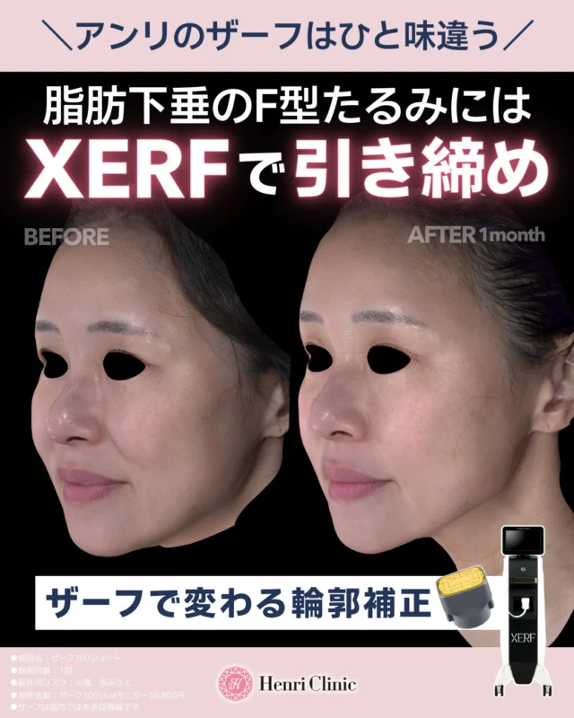 ＼ ザーフで圧倒的な結果／✨

脂肪が多く下に落ちた“F型たるみ”😣
浅いタイトニングでは引き上がらない方にはザーフでしっかりと引き締めがオススメ💙

6.78MHz＋2MHzのデュアル周波数⚡
脂肪深部まで熱エネルギーを届け、
ディープモードで下垂脂肪に直接アプローチ🔥

引き締め&引き上げにはザーフです🧬✨

━━━━━━━━━━━━━━
▶︎こんな方におすすめ

✔ 脂肪多めでフェイスラインがもたつく
✔ 口ポニョ・あご下が気になる
✔ 痛みを抑えてたるみ治療をしたい
✔ ハイフで満足できなかった

━━━━━━━━━━━━━━

【2月キャンペーン価格】🎉

▪ 頬＋あご下 300shot
　¥55,000 → ¥44,000

▪ 全顔＋あご下 400shot
　¥66,000 → ¥55,000

▪ 全顔＋あご下＋首 600shot
　¥99,000 → ¥82,500

▪ XERFULL 800shot
　¥132,000 → ¥110,000

▪ シャワー150shot（Shallowのみ）
　¥33,000 → ¥29,800

━━━━━━━━━━━━━━
📌適用条件
当院Instagramフォロー＋この投稿にいいね👍

📌初診料 ¥0
📌施術回数：1回
📌副作用：発赤・熱感・軽度腫脹など
📌ザーフは日本国内未承認機器です

━━━━━━━━━━━━━━

「安い」だけではありません。
理論があるから、結果が出る📈

名古屋でRFたるみ治療を選ぶなら
アンリクリニック名古屋院へ🏥✨

ご予約はWEBから📲
プロフィールリンクよりどうぞ🔗

#アンリクリニック名古屋院#ザーフ
