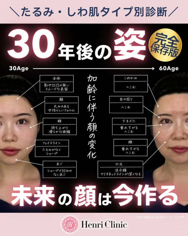 30年後の顔はどう変わる？🦴👵

たるみやシワは突然できるわけではありません！😮

実は顔は年齢とともに少しずつ変化しています🌿

老化で起こる顔の変化☺
✔ 骨の萎縮
✔ 脂肪の下垂
✔ 靭帯のゆるみ
✔ 筋肉バランスの変化
✔ 真皮のコラーゲン減少

これらが重なり合い徐々に時間をかけて顔の印象は大きく変化します😢

より若々しく、できる限りスローエイジングを目指していくために大切なのは「どこが原因なのか」を見極めること🌼

アンリクリニックでは皮膚・脂肪・筋肉・骨のレイヤー構造（層別）で治療を提案しています🥼💉

👀顔のたるみタイプ別
貴方はどれ？🔍
✔ 脂肪たるみ型
✔ 骨萎縮型
✔ 筋肉過緊張型
✔ 真皮老化型
✔ 靭帯ゆるみ型

同じ「たるみ」に見えても
原因は人によって全く違います😮

そのため“その人に合った治療選択”が重要です🥰

アンリクリニックで可能な治療🏥
・ボトックス
・肌育注射
・スレッド
・エネルギーデバイス
などを組み合わせ
層別アプローチで治療を行っています✨

将来の顔を決めるのは「今のケアと選択」です💯

未来の顔は、今つくる😊

たるみ診断をご希望の方はお気軽にご相談くださいませ✨

📍アンリクリニック名古屋院

#アンリクリニック名古屋院