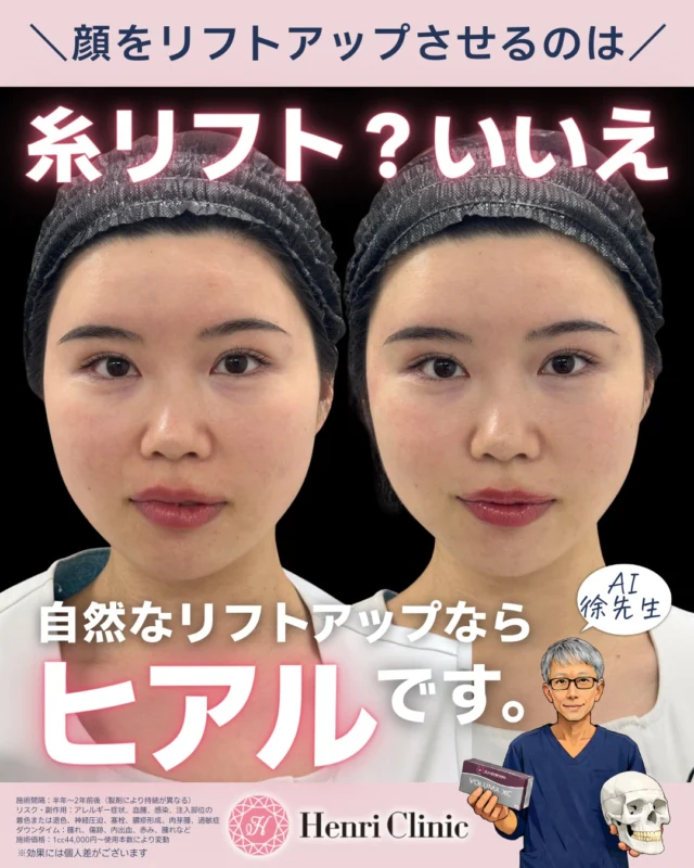 「糸リフトしなくても顔はリフトアップできます。」

実は・・・
ヒアルロン酸注入でも自然なリフトアップは可能です✨

🧵糸リフトは皮膚を物理的に引き上げる治療ですが、

ヒアルロン酸注入は顔の重心・骨格バランスを整えることで自然にリフトアップさせる治療です💉

💡ヒアルロン酸注入のメリット
✔ 不自然な引きつれ感が出にくい
✔ 顔全体のバランスを整えられる
✔ 小顔効果が出やすい
✔ ダウンタイムが比較的少ない
✔ 自然な若返りが可能

さらに実は…

徐先生だけの秘密ポイントあり🤫✨

骨格・靭帯・脂肪の位置を見極めながら通常とは少し違うポイントに注入することで
💉“引っ張った感じのない自然なリフトアップ”💉
を作ることが可能です。

当院のヒアルロン酸はただシワを埋める治療ではありません😮

骨格や靭帯の位置を考えながら上・横・下にテンションを分散させることで顔全体のバランスを整え、自然に若々しい印象へ導きます✨

✔ 糸リフトに抵抗がある方
✔ 自然に若々しくなりたい方
✔ 小顔になりたい方
✔ ダウンタイムを少なくしたい方

このような方には
アンリのヒアルロン酸リフトがおすすめです😊💗

📍アンリクリニック名古屋院
ご予約はプロフィールリンクから📲

#アンリクリニック名古屋院
#ジョヒアル#ヒアルロン酸注入