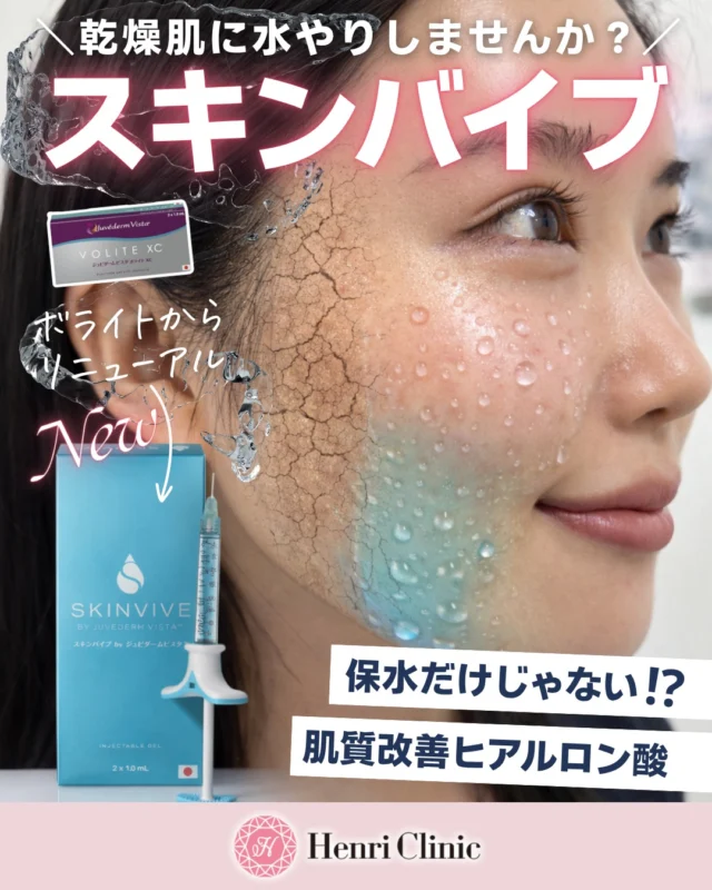 スキンバイブ新登場🆕乾燥肌に、水やりしませんか？💧✨

新しくリニューアルしたスキンバイブ（SKINVIVE） は、アラガン社のヒアルロン酸製剤の中でも“肌質改善”を目的とした次世代肌育製剤です🤍😮

「ヒアルロン酸＝ボリュームを出すもの」というイメージを持たれる方も多いですが、
スキンバイブはそれとは少し違います👏

スキンバイブは真皮に直接アプローチして、お肌の保水力・なめらかさ・ツヤ感を高め、乾燥、小じわ、赤み、キメの乱れなど肌質そのものを整えていく治療です🫧

さらに注目したいのが、真皮の線維芽細胞を生成して、お肌の土台から健康にさせてくれること🔥
線維芽細胞は年齢と共に徐々に減っていくことにより、コラーゲンやエラスチンを生み出すことが困難になることで、肌は老化をしていきます😢

スキンバイブは注入を行うことで、お肌の土台からしっかりと健康に導いてくれます✨

そしてもう一つのポイントはアクアポリン3の発現量上昇💡
水分輸送に関わる働きが高まることで、お肌のバリア機能や水分保持機能をサポートし、うるおいのある肌へ導いてくれます🚙

そしてそして・・・スキンバイブは“顔だけ”ではありません！😍

✔ 手の甲の痩せ感
✔ 首の横ジワ
など、年齢が出やすい部位にもおすすめです✨

1回でも変化を実感される方が多く、
最大9か月の持続効果が期待できるのも魅力です💎

「スキンケアだけでは乾燥が追いつかない」
「ツヤ感がなくなってきた」
「小じわやキメの乱れが気になる」
「首や手元まできれいにしたい」
そんな方にぴったりです☺️

【料金】
スキンバイブ
定価 1cc ¥33,000
2cc以上で 1cc ¥26,400
※別途カニューレ代 ¥3,300
※当院は安全のためカニューレ針を使用して施術しております
※2cc以上から20%OFF適用

ご予約は
WEB・お電話・LINEより承っております📩
☎️ 052-269-2244

気になる方はぜひご相談ください✨

#アンリクリニック名古屋院 #スキンバイブ#skinvive