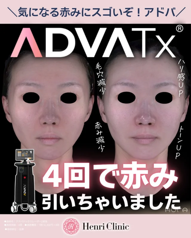 その赤み、まだ我慢してますか？

✔ 顔の赤みがずっと引かない
✔ ニキビ跡の色味が残る
✔ ファンデで隠すのが当たり前

赤みはアドバにお任せ下さい✨💝

今回ご紹介するのは
＼アドバテックスレーザー（ADVATx）／

実際の症例では👇
✔ 4回で赤みがしっかり改善
✔ 肌トーンUP・透明感アップ
✔ 毛穴やニキビ跡にもアプローチ

💡ポイントは「2波長」
・589nm → 赤み・炎症・メラニンへ
・1319nm → 皮脂・毛穴・肌質改善へ

👉 赤みだけじゃなく“肌全体”を底上げ😎

「もう治らないと思ってた」
そんな方こそ一度ご相談くださいませ😊

📍栄駅徒歩5分
💡初診料 ¥0
📱ご予約はWEBから

※効果には個人差がございます