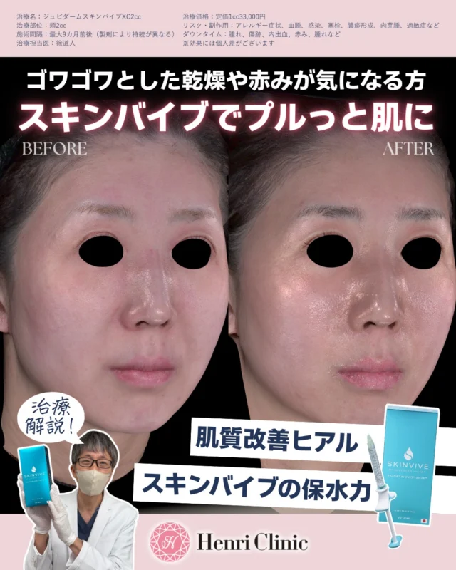 💧スキンバイブ症例解説

乾燥で肌のうるおいが低下すると、外的刺激を受けやすくなり、赤みが目立ちやすくなることがあります😢

本症例では、スキンバイブで肌のうるおい感や質感が整ったことで、乾燥由来の赤みが落ち着いて見られました✨

赤みを直接治療したというより、肌環境が整った結果として、全体の印象がなめらかに見えた症例です🫧

こんな方にスキンバイブはオススメ✨
✔︎ 乾燥が気になる
✔︎ 肌の質感を整えたい
✔︎ 自然なハリ感がほしい
✔︎ スキンケアだけでは肌質改善が難しいと感じている

そんな方の選択肢のひとつとしてご相談ください👩🏻‍⚕️💉

※適応は医師の診察により判断します
※効果には個人差があります
※赤みの原因はさまざまで、すべての症例に同様の変化を示すものではありません

💉治療概要🥼
治療名：ジュビダームスキンバイブXC2cc
治療部位：頬2cc
⁠施術間隔：最大9カ月前後（製剤により持続が異なる）⁠
治療担当医：徐道人
治療価格：定価1cc33,000円
リスク・副作用：アレルギー症状、血腫、感染、塞栓、膿疹形成、肉芽腫、過敏症など⁠
ダウンタイム：腫れ、傷跡、内出血、赤み、腫れなど⁠
※効果には個人差がございます