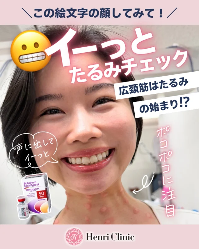 イーっとしてみて😬実はたるみが出てくるサインです🫣🤙

「イーっとしたときに首の筋が浮き出る」
それ、広頚筋の過緊張かも🙈

実は広頚筋は発達しすぎるとたるみの原因にも💦

■なぜたるむのか？🧠
表情筋は
💪挙上筋（引き上げる）
👇下制筋（引き下げる）
のバランスで成り立っています

加齢によりこのバランスが崩れると
💧下方向への張力が優位になりフェイスラインのもたつきの原因に🥲

特に広頚筋は下制方向に強く引く筋肉のため
たるみ・縦ジワの原因になります🌬️

■広頚筋ボトックスで緩める治療がおすすめ💉
広頚筋にボツリヌストキシンを注入し
・筋緊張を部分的に抑制
・下方向の牽引力を弱める

こんな効果が期待できます✨
🌿フェイスラインの引き上げバランスが回復
🌿首の縦ジワ・もたつき改善が期待されます

■適応の見極め🔍
✔ イーっとしたときに首筋が浮き出る
✔ フェイスラインが下に引かれる感じがある
✔ 首の縦ジワが目立つ
一緒にイーっと😬この顔文字でチェックしてみてね！

■重要な注意点⚠
広頚筋の深層には
👉 舌骨下筋群（嚥下に関与する筋）が存在
過度に深く作用すると嚥下障害などのリスクあり🫨

そのため解剖を理解した医師による適切な層・量のコントロールが必須🥼

■効果の目安📊
・効果発現：数日〜1週間程度
・持続：3〜6ヶ月程度
（個人差あり）

まとめ🪞
フェイスラインや首のたるみは「皮膚」だけではなく筋肉バランスの問題であるケースも多いです📝

だからこそ正しく筋肉にアプローチすることが重要です💪

ボトックスはアンリクリニック名古屋院にお任せください🔥💉

#ボトックス