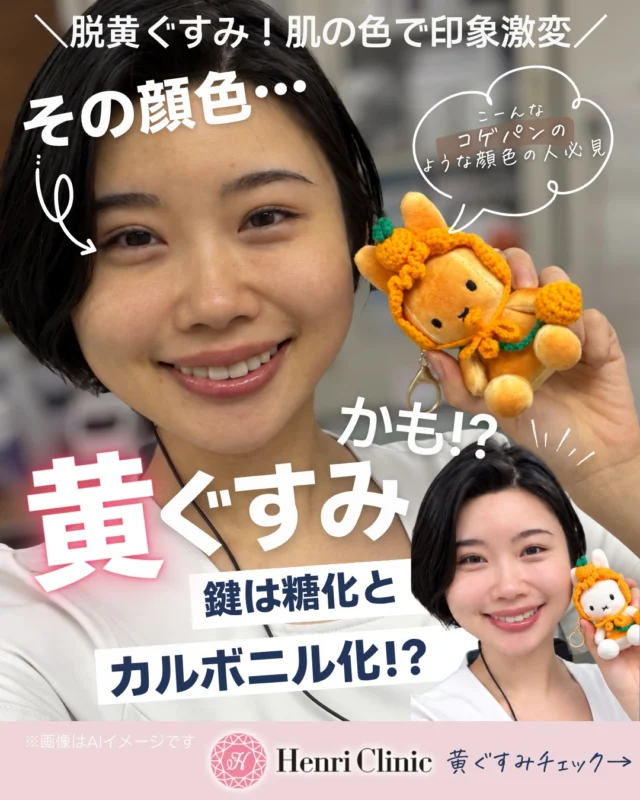 🍋 その顔色、「黄ぐすみ」かも？🤢

✅なんとなく顔色が冴えない
✅以前より黄色っぽく見える
✅透明感やツヤがなくなった気がする……

そんな肌印象の変化には、紫外線や乾燥、生活習慣などさまざまな要因が関係します😢

その中で注目されているのが
「糖化」と「カルボニル化」です🧁☀️

糖化は、糖とタンパク質が反応してAGEs（終末糖化産物）などが生じる反応🧬
カルボニル化は、脂質の酸化などによって生じた反応性物質がタンパク質に結びつく反応です🔥

これらは皮膚タンパク質の性質に影響し、加齢に伴う肌色・ハリなどの変化との関連が研究されています🔬✨

ただし、「肌が黄色い＝糖化している」と見た目だけで診断することはできません💁
黄ぐすみのように見える背景には、紫外線、乾燥、色素沈着、血色、角質状態など複数の要因があります！

投稿内のチェックリストで
「最近ちょっと当てはまるかも？」を確認してみてください📝💗

まず意識したいのは毎日の習慣🏃

🍰 糖質に偏りすぎない食生活
☀️ 日常的な紫外線対策
😴 十分な睡眠
🚭 喫煙を避ける
🧴 保湿・スキンケア

肌状態によっては、美容医療を選択肢のひとつとして検討することもできます💁

アンリクリニック名古屋院では、診察で肌状態を確認したうえで、IPL光治療・経皮導入・注入治療などから適応を判断しています👩🏻‍⚕️✨

【施術MENUのご紹介】

🌟BBL HEROic
IPL（光）を肌に照射する施術です。
料金：全顔1回 13,200円〜
主なリスク・副作用：赤み、熱感、腫れ、痛み、乾燥、かさぶた、水疱・熱傷、色素沈着など。

✨メソナJ
電気的な技術を用いて美容成分を皮膚へ導入する施術です。
料金：1回 9,900円〜
主なリスク・副作用：赤み、刺激感、かゆみ、乾燥、使用する製剤によるアレルギー反応など。

💉ピンクグロー
製剤を皮膚へ注入する治療です。
料金：1回 24,100円〜
主なリスク・副作用：疼痛、赤み、腫れ、内出血、かゆみ、感染、アレルギー反応など。

※ピンクグローは日本国内で承認されていない製剤を使用する治療です。国内承認品と同一の成分・性能を有する製剤がない場合があります。入手経路・諸外国における安全性情報等については、診察時および院内の表示をご確認ください。国内未承認医薬品による健康被害は、医薬品副作用被害救済制度の対象外となる場合があります。

💡ご案内
効果・経過には個人差があります。
医師の診察により、施術をお受けいただけない場合があります。

📍アンリクリニック名古屋院
📞 052-269-2244
ご相談・ご予約はWEBより承っております。

#黄ぐすみ #糖化 #カルボニル化 #AGEs