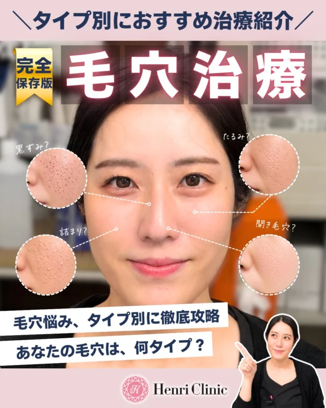＼その毛穴悩み、原因に合わせてケアできていますか？🔍／

一言で「毛穴」といっても、
実は見え方や原因はさまざま。

✔︎ 開き毛穴
✔︎ 黒ずみ毛穴
✔︎ たるみ毛穴
✔︎ 詰まり毛穴

毛穴の状態によって、適したアプローチも異なります🫧

Henri Clinicでは、肌状態を確認しながら
一人ひとりに合わせた治療をご提案しています。

今回の投稿では、
毛穴4タイプの特徴・原因から、おすすめの治療までまとめました✨

「毛穴治療、何を選べばいいかわからない…」
そんなときの参考に、ぜひ保存して見返してください📖♡

気になる施術については、お気軽にご相談ください。

※効果・経過には個人差があります。
※施術には副作用・リスク・ダウンタイムが生じる場合があります。
※適応となる施術は肌状態によって異なります。

#毛穴#アンリクリニック名古屋院