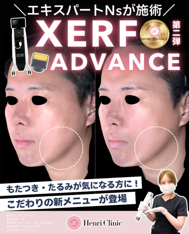 XERF ADVANCE 👑

あのザーフから遂に待望のアドバンスシリーズが登場しました✨📣
エキスパートナースが一人ひとりに合わせて照射デザイン✨

同じ「たるみ」「もたつき」のお悩みでも、脂肪のつき方やフェイスライン、気になる部位は人それぞれ💁‍♀️🌿

XERF ADVANCEでは、お顔の状態を確認しながら
✔︎ Shallow
✔︎ Middle
✔︎ Deep
の照射モードを使い分け、全顔＋あご下に600shotを照射します💎

当院では、院内基準を満たした「エキスパートナース」が担当🔥

単にショット数を増やすのではなく、気になる部位やお顔全体のバランスを確認しながら照射範囲・モードを調整します🪄

今回の症例では、フェイスライン〜あご下を中心に照射しています🗒️
施術後はフェイスラインの変化がみられていますが、治療効果には個人差があります。

さらに「ここも追加で照射したい」という方には、追加100shotの「ちょこザーフ」もご用意しています🌿🤏

📍XERF ADVANCE
施術内容：高周波（RF）による全顔＋あご下への照射
照射数：600shot
施術回数：1回
通常料金：99,000円（税込）
キャンペーン料金：79,200円（税込）
※キャンペーン期間・適用条件は投稿画像をご確認ください。

➕ちょこザーフ
追加100shot
通常16,500円（税込） → 13,200円（税込）

⚠️主なリスク・副作用
赤み、熱感、腫れ、疼痛、圧痛、むくみ、乾燥、内出血、やけど、色素沈着などが生じる可能性があります。症状や治療効果には個人差があります。

📱ご予約はLINE・WEBより承っております。

#アンリクリニック名古屋院
#HenriClinic
#XERF
#ザーフ