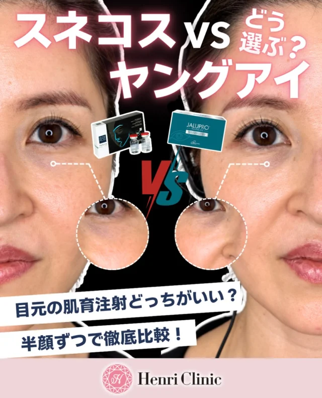 ＼ スネコス vs ジャルプロヤングアイ👀💉 ／
目元の肌育注射、結局どっちを選べばいい？🤔

目元は皮膚が薄く、乾燥やハリ不足などが気になりやすいデリケートなパーツ。

今回は、アンリクリニックで取り扱っている
「スネコスパフォルマ」と「ジャルプロヤングアイ」を半顔ずつ施術し、それぞれの特徴を比較しました✨

🌿 スネコスパフォルマ
非架橋ヒアルロン酸＋6種類のアミノ酸を配合。
ECM（細胞外マトリックス）に着目し、コラーゲン・エラスチンの生成をサポート。
ハリ・弾力・うるおいのある肌を目指します。

こんな方におすすめ👇
✔︎ ハリ・弾力不足が気になる
✔︎ キメや質感を整えたい
✔︎ 自然な仕上がりを目指したい

🩵 ジャルプロヤングアイ
2種類の低分子非架橋ヒアルロン酸に、7種類のアミノ酸＋3種類のペプチドを配合した目元に特化した肌育製剤。
目元のハリ・弾力をサポートし、小じわ・クマ・くすみなどのお悩みにアプローチします。

こんな方におすすめ👇
✔︎ 目元のハリ不足が気になる
✔︎ ちりめんジワが気になる
✔︎ 目元に自然なふっくら感がほしい
✔︎ 目の下が痩せて見えるのが気になる

💡 どちらを選ぶ？
広い範囲の肌質やハリ・弾力を整えたいなら「スネコス」、
目元を集中的にケアしたいなら「ジャルプロヤングアイ」など、お悩みや目指す仕上がりに合わせて選択することがポイントです✨

「自分にはどっちが合う？」という方は、診察時にお気軽にご相談ください🩺

気になった方は、あとから比較できるように
保存して見返してみてください🔖

※施術の効果・経過には個人差があります。
※施術後に赤み・腫れ・膨疹・内出血などが生じる場合があります。

#アンリクリニック名古屋院
#ジャルプロヤングアイ
#スネコスパフォルマ