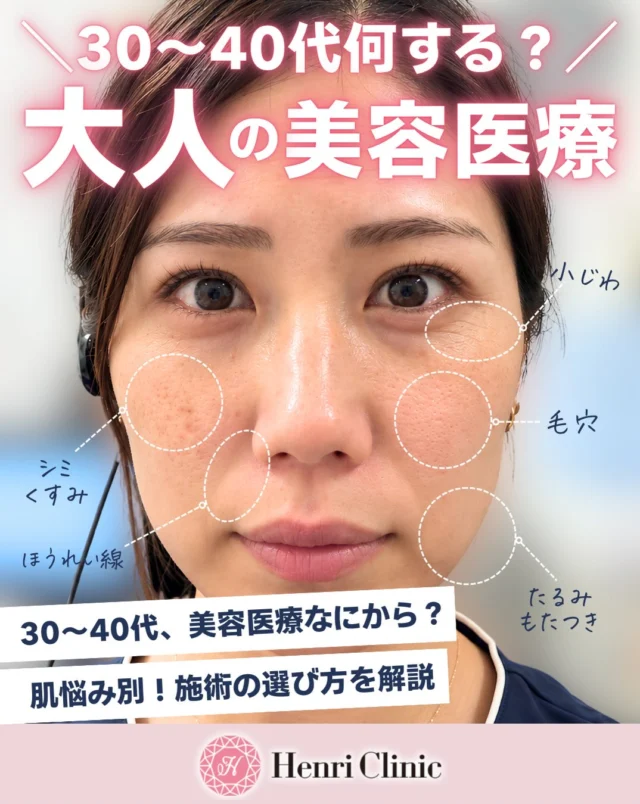 ＼30〜40代、何から始める？大人の美容医療🪞✨／

「最近、肌の変化が気になってきた…」
「美容医療に興味はあるけど、何を選べばいいの？」

30〜40代は、シミ・くすみ・毛穴・小じわ・たるみなど、さまざまな肌悩みが気になり始める年代。

実は、同じ年代でも肌状態やお悩みによって、適した施術は異なります💡

今回は、30〜40代に多いお悩み別に、アンリクリニックおすすめの美容医療をご紹介します🫧

🔍 お悩み別おすすめ施術

✔ シミ・くすみ
→ BBL HEROic｜光治療で色ムラにアプローチ

✔ ほうれい線・頬の下がり
→ リフトアップヒアル｜お顔全体のバランスを見ながら自然な印象へ

✔ 毛穴・肌のざらつき
→ MOXI｜肌のキメを整え、なめらかな肌印象へ

✔ 小じわ・ハリ不足
→ スキンプラス｜肌のハリ・弾力をサポート

✔ たるみ・フェイスラインのもたつき
→ XERF｜高周波で肌の引き締め・ハリ感にアプローチ

大切なのは、年齢だけで施術を選ぶのではなく、今の肌状態やお悩みに合ったケアを選ぶこと。

「自分にはどの施術が合っている？」
「何から始めたらいいか分からない…」

そんな方も、ぜひお気軽にご相談ください🤍

📌 あとで見返せるように保存がおすすめ！

※施術の適応・効果には個人差があります。各施術には赤み・腫れ・内出血などのリスクがあり、診察のうえ適切な治療をご提案します。

#アンリクリニック名古屋院