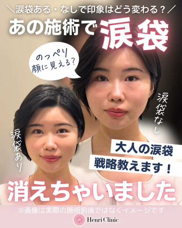 👀✨ 「涙袋を作りたい」その施術、本当に合っていますか？ ✨👀

目の下ボトックスを受けたあと、
😳「涙袋がなくなった…」
🥲「なんだか目元がのっぺりした…」
と感じることがあります。。。

実は、涙袋の正体は👇
💡 下まぶたにある眼輪筋の厚みと収縮によるふくらみなんです！

そのため、下まぶたの眼輪筋にボトックスが効きすぎると、筋肉の動きが弱まり、涙袋の立体感が減って見えることがあります⚠️

つまり…
❌ 目の下のシワが気になる＝目の下ボトックスが必ず正解
ではありません🙅‍♀️

特に大人の目元は、
👁 眼輪筋のボリューム低下
🫧 眼窩脂肪の突出
📉 皮膚のたるみ
💭 目元の凹み 
などが複雑に重なっていることもあります😢

涙袋だけを見て施術を選ぶと、
逆に目元が平坦に見えたり、クマが強調されて見えることも…😨

今回の投稿では📖✨
✔️ 涙袋がなくなる仕組み
✔️ 涙袋と「目袋」の違い
✔️ 大人の涙袋に合う施術の考え方
をまとめました📚

大人の目元は、
💉 “足す”だけでも
🧊 “動きを止める”だけでも
不十分なことがあります。
大切なのは、
筋肉・凹み・脂肪・皮膚の状態を見ながら施術を選ぶことです👨‍⚕️✨

当院では状態に応じて👇
💪 エムフェイス
→ 眼輪筋へのアプローチ
💉 クマコラ注射
→ 目元の凹みへのアプローチ
💎 ヒアルロン酸注入
→ ボリューム不足へのアプローチ
などを組み合わせてご提案しています🌸
「涙袋は残したいけど、目の下のシワは気になる」
「最近、涙袋より目袋っぽく見えてきた」
「何をしたらいいかわからない…」
そんな方は、施術を決める前に一度ご相談ください🩷

────────────
※自由診療です。
※適応・効果・経過には個人差があります。
※ボツリヌストキシン注射では、左右差、表情の変化、違和感、腫れ、内出血等が生じる場合があります。
※ヒアルロン酸注入では、腫れ、内出血、左右差、血流障害等のリスクがあります。
※施術内容は診察のうえ決定します。

アンリクリニック名古屋院🏥
⏱営業時間：10：00～20：00