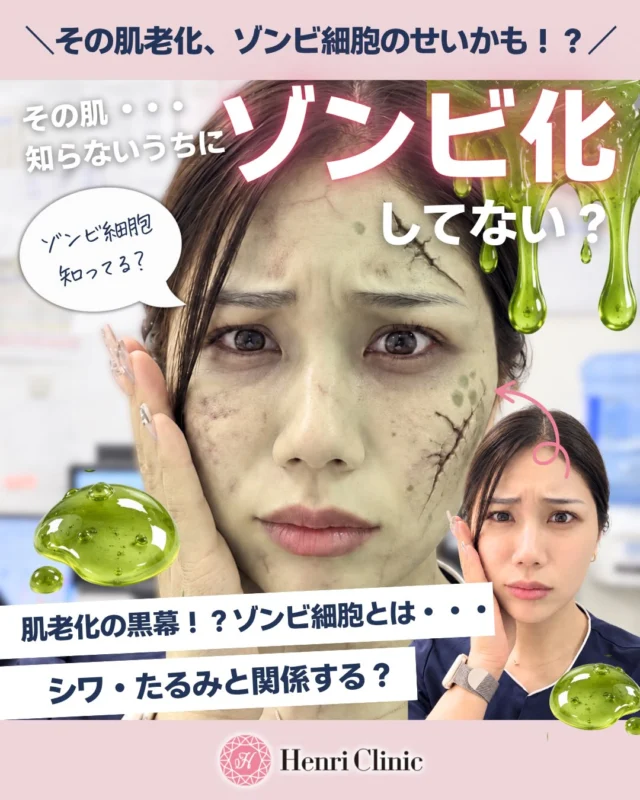 🧟‍♀️ その肌老化、ゾンビ細胞のせいかも！？

最近、シワやたるみ、くすみが気になってきた…💭

実はその肌悩み、「ゾンビ細胞」が関係しているかもしれません👀

🧟‍♀️ ゾンビ細胞とは？

紫外線やストレス、加齢などによってダメージを受け、細胞分裂を停止しても体内に残り続ける「老化細胞」のこと。

一部の老化細胞は炎症に関わる物質を放出し、周囲の細胞や組織にも影響を与えることが知られています。

⚡ 肌に現れる可能性のある変化
✔ シワ・小ジワ
✔ ハリ・弾力の低下
✔ くすみ・色むら
✔ 炎症・赤み

肌老化とゾンビ細胞の関係は、現在も研究が進められています🔬

大切なのは、日頃から肌へのダメージを防ぎ、健やかな肌環境を整えること✨

Henri Clinicでは、お肌の状態やお悩みに合わせたスキンケア・美容医療をご提案しています🩷

気になる方は、ぜひお気軽にご相談ください💉

📌 後から見返せるように保存がおすすめ！

#アンリクリニック名古屋院